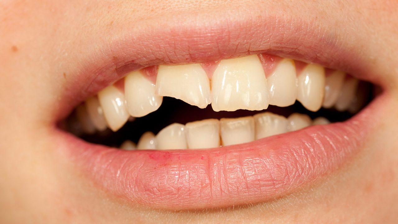 Symptoms of a chipped tooth