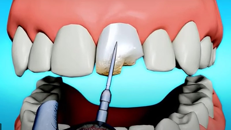 Chipped Tooth Garland, TX - Broken Teeth Treatment - Dental Filling